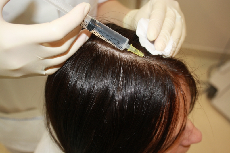 Мезотерапия волос в Волгограде