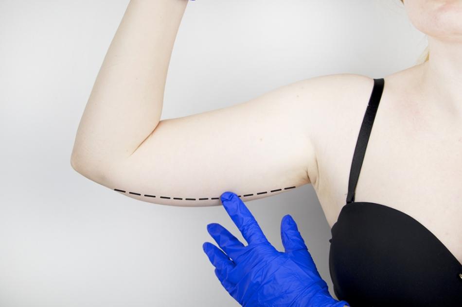 Как проходит операция брахиопластики рук?